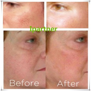 Ipartner LS980 Faigheann an Córas Sásaimh ó Dhé-óid Laser